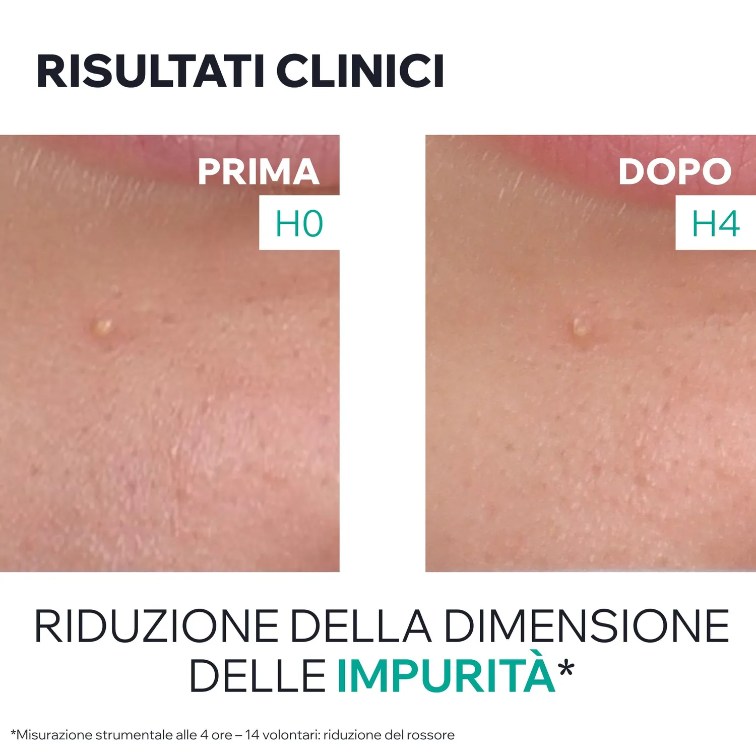 Uriage Hyseac Gel SOS Purificante brufoli AHA BHA